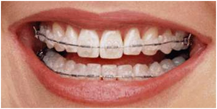 Ceramic Braces In London Waterloo